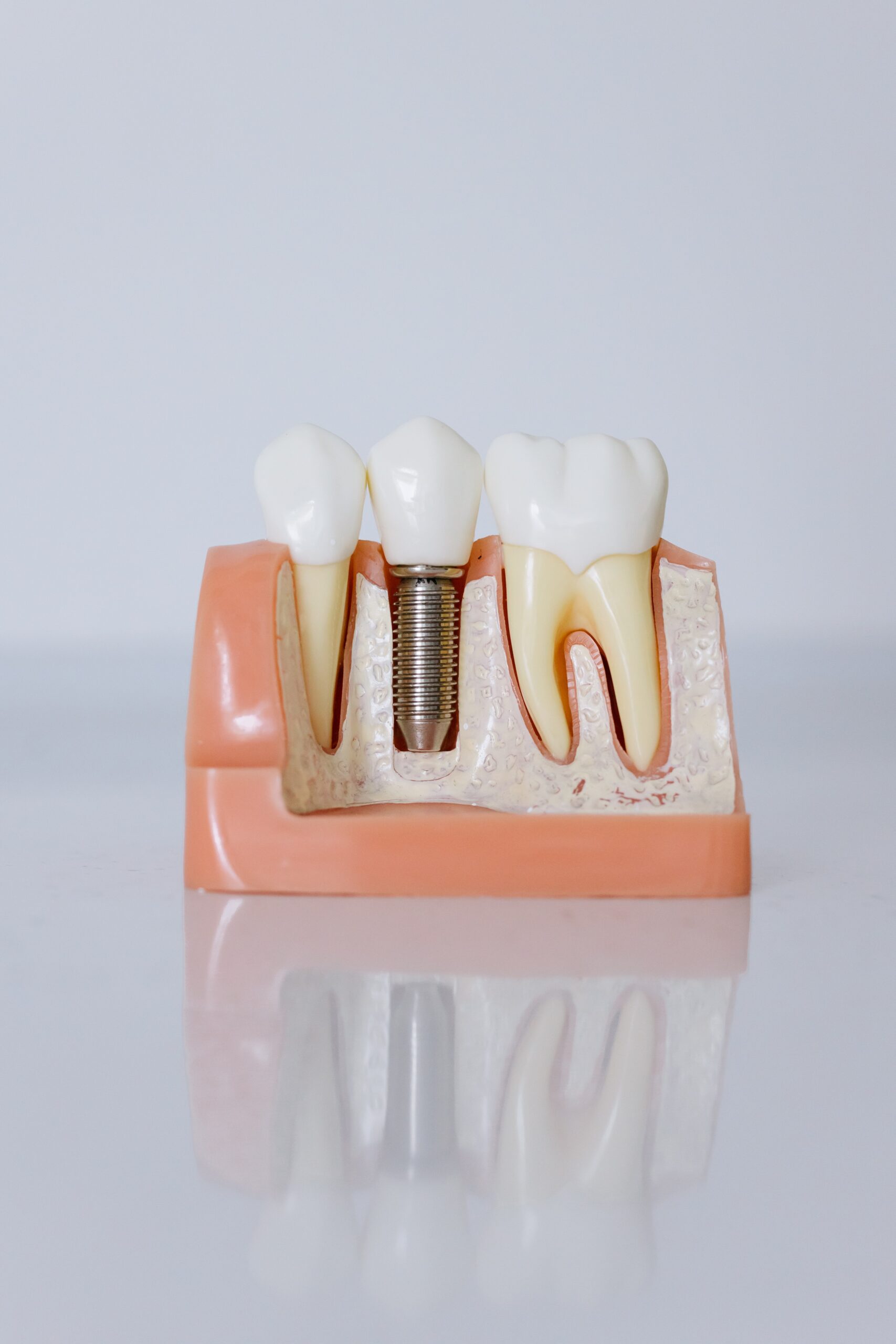dental implant example