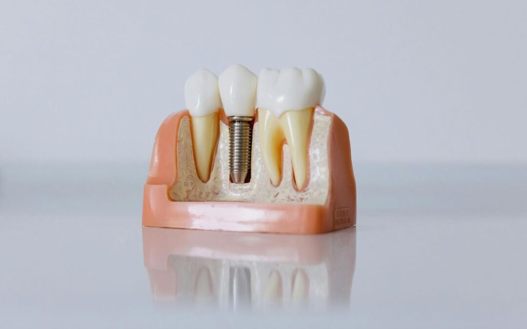 Are Dental Implants Better Than Real Teeth?