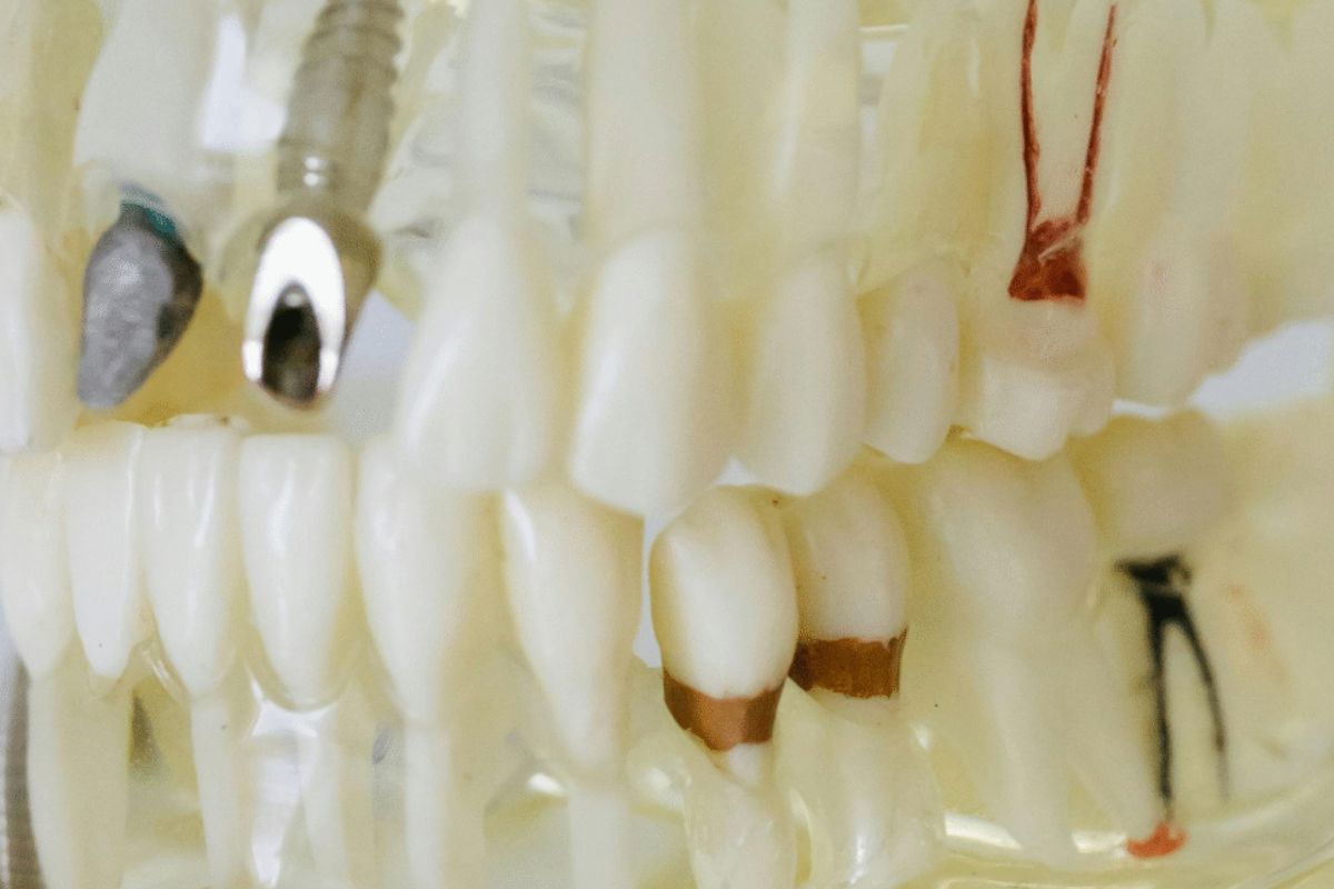 advantages-of-choosing-a-prosthodontist-for-implants-in-Honolulu